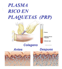 plasma rico en plaquetas (PRP)